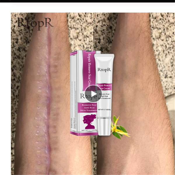 Acne Scar Healing Cream for Radiant Skin