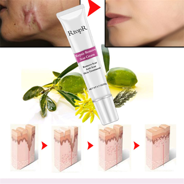 Acne Scar Healing Cream for Radiant Skin