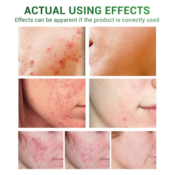 Scar Diminish &amp; Skin Enhance Oil