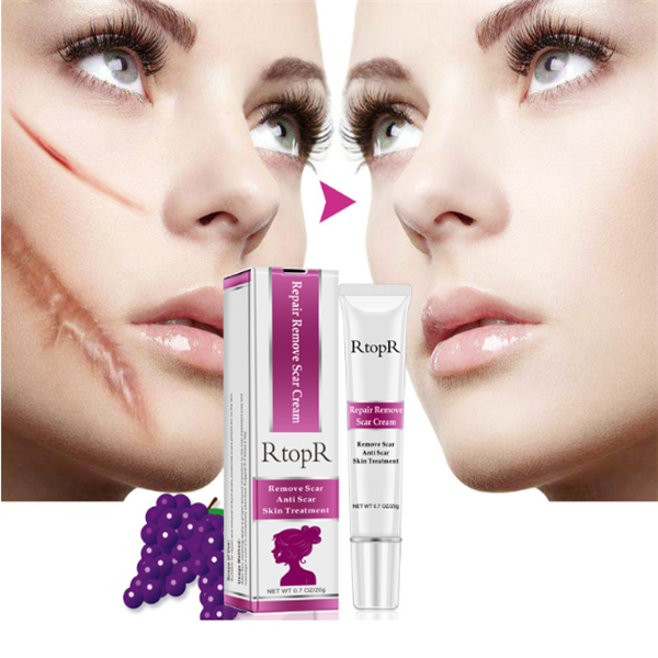 Acne Scar Healing Cream for Radiant Skin