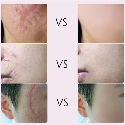 Acne Scar Healing Cream for Radiant Skin