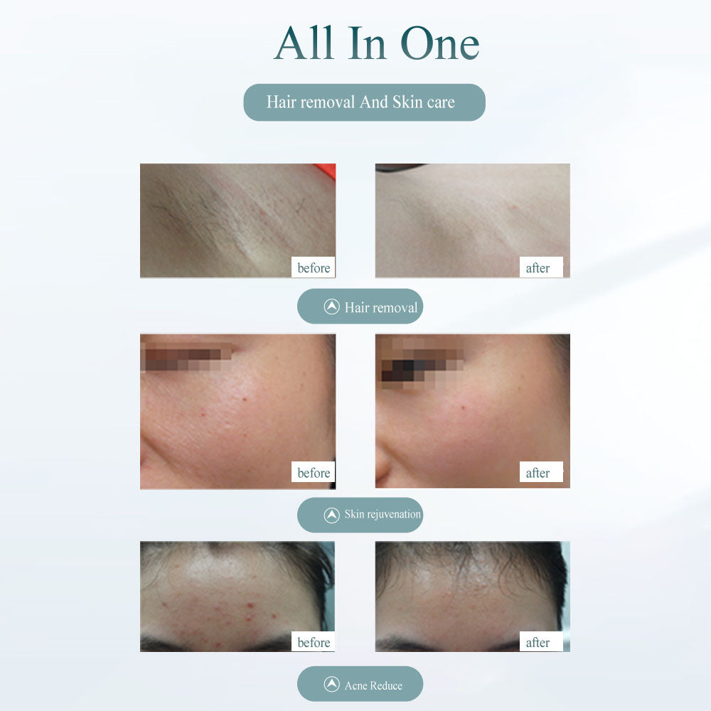 SmoothPulse Laser Hair Remover