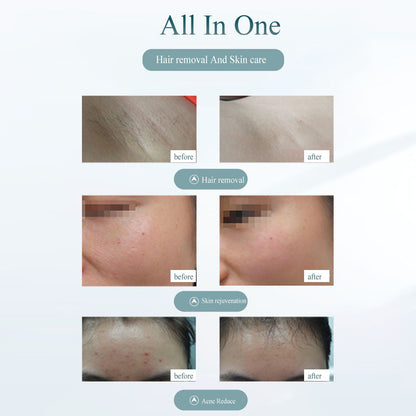 SmoothPulse Laser Hair Remover
