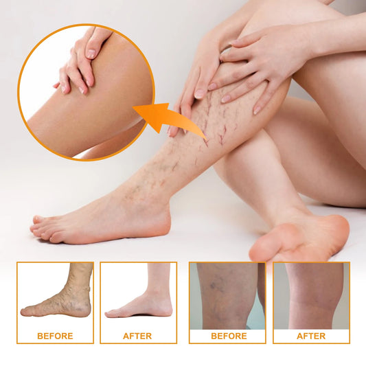 Smooth Veins Relief Cream